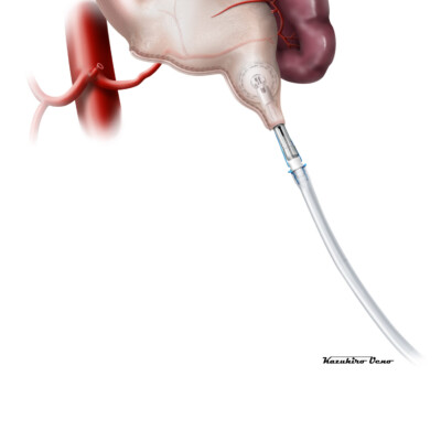 医学・シェーマ CG/イラストレーション制作事例:医学・シェーマ